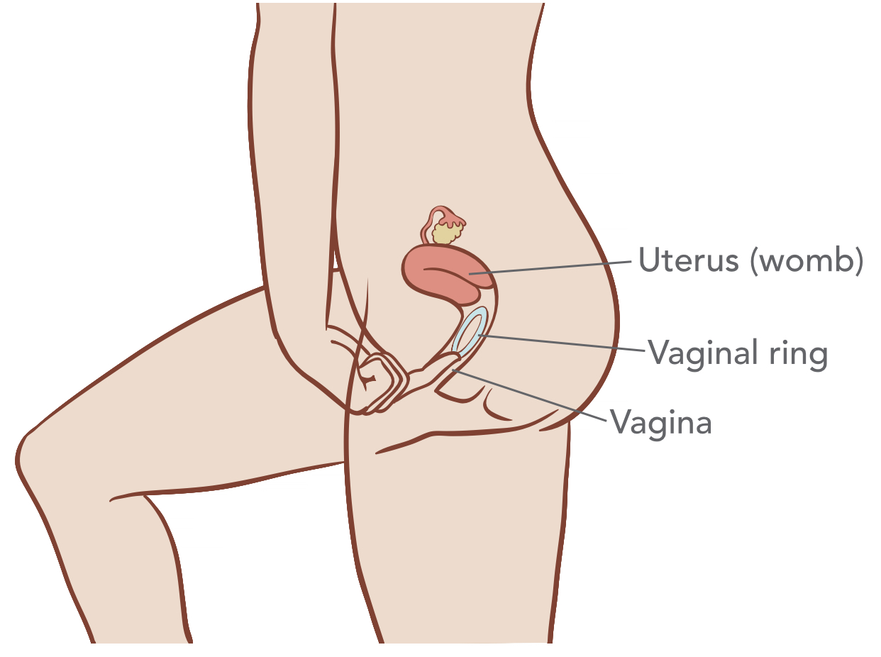 Vaginal Ring inserted in vagina to prevent pregnancy
