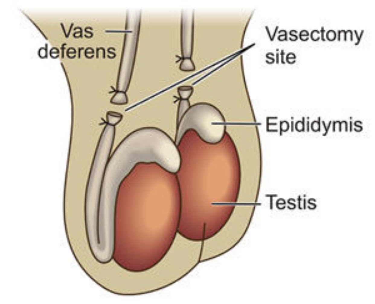 Vasectomy as a form of sterilization or permanent contraceptive method in men