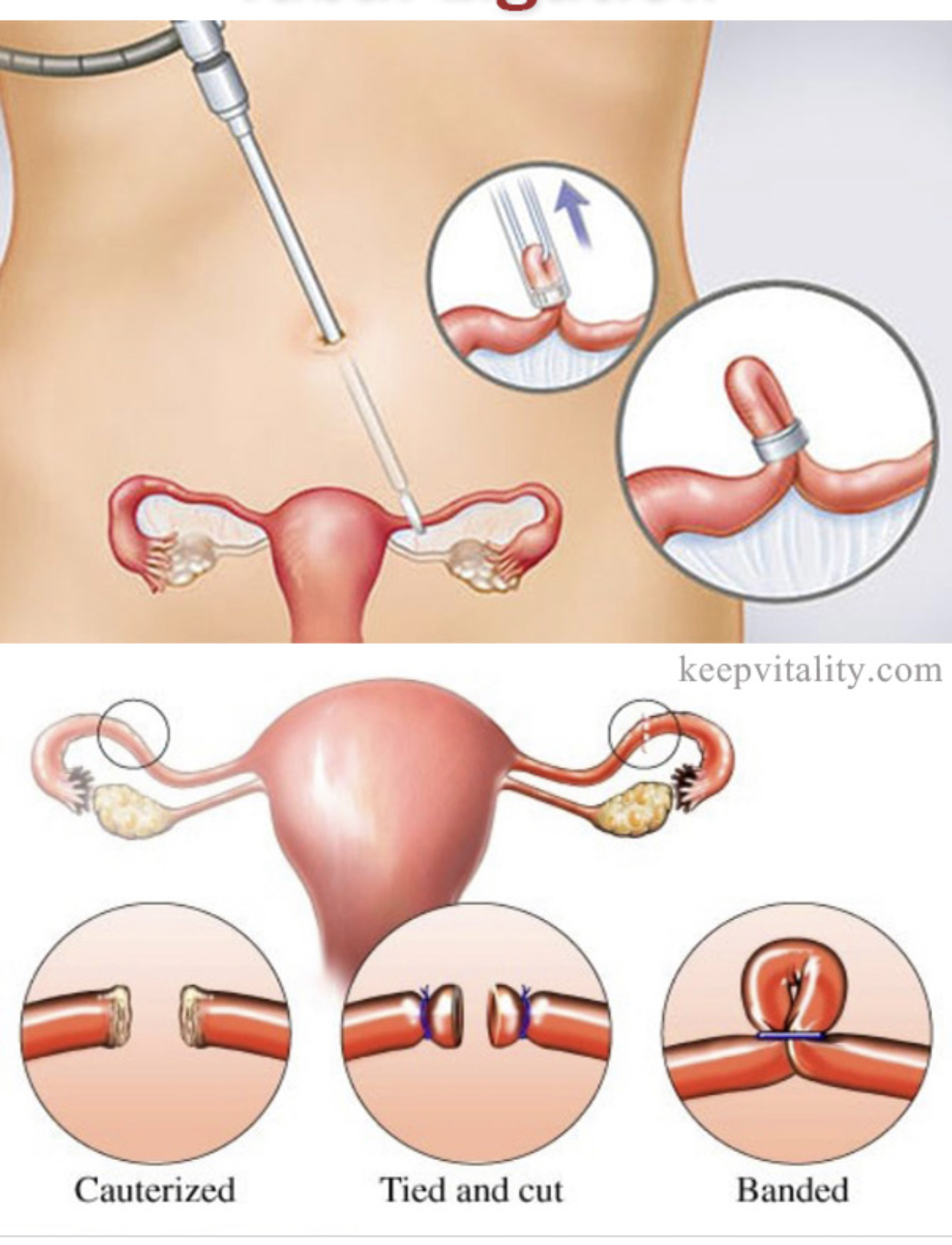 Tubal ligation or tying of tubes in women as a permanent contraceptive method